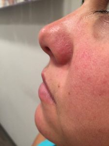 rosacea