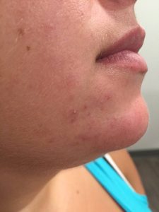 rosacea2