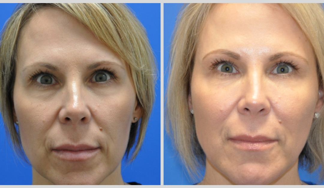 Non-Surgical FaceLifts and Dermal Fillers