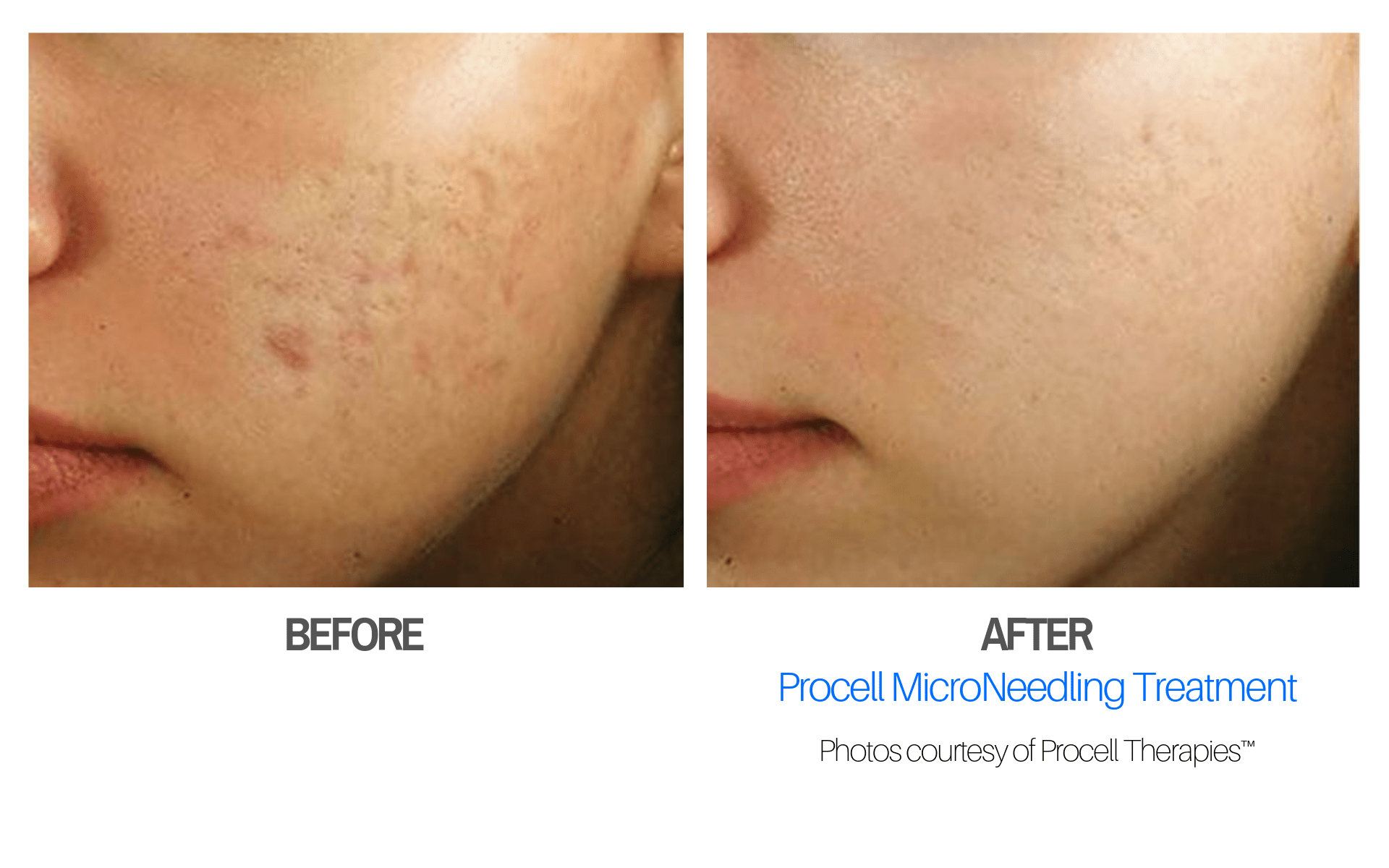 Microneedling SONA MD