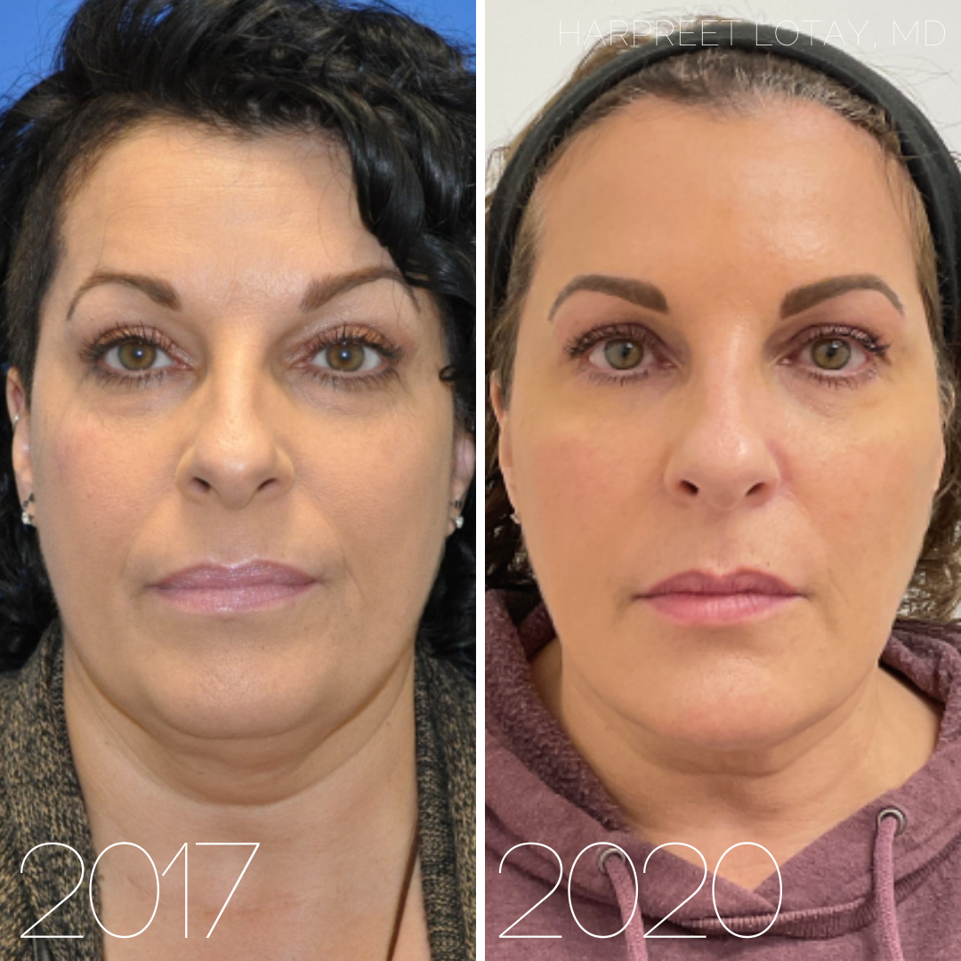 Botox & Dermal Filler Transformation
