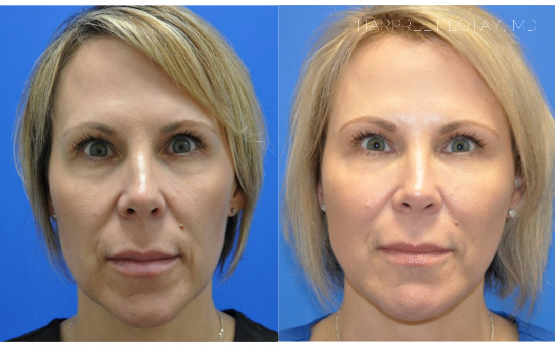 Unlocking the Secrets of Ageless Beauty with Dermal Fillers