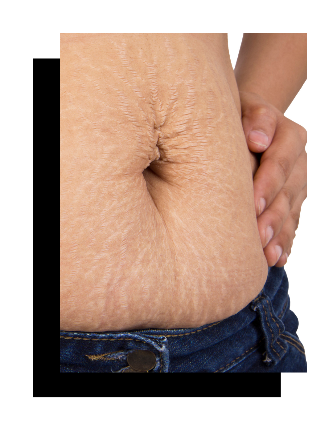 NON-SURGICAL TUMMY TUCK - SONA MD - Botox, Dermal Fillers Kamloops