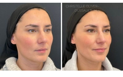 A Subtle Transformation: The Artistry of Lip Filler with Dr. Oliver-Dussault
